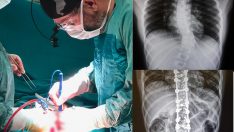 Fatsa Devlet Hastanesinde Omurga Eğriliği Ameliyatı Başarıyla Yapıldı